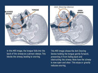 Apnea Tongue Stabilizing Device